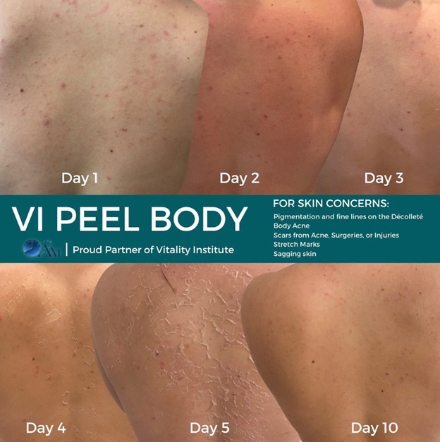 VI peel Body