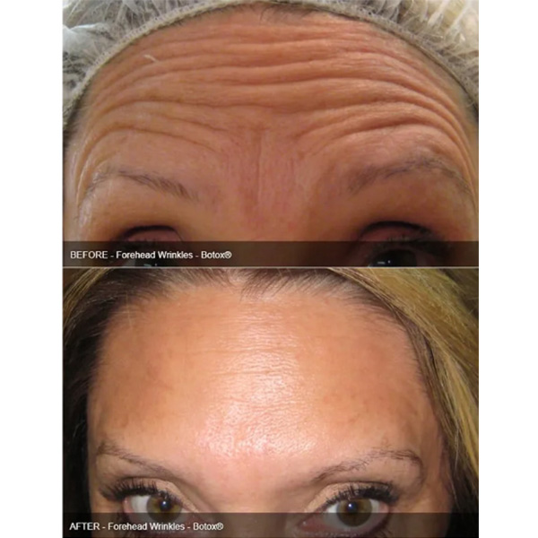 Botox Before After